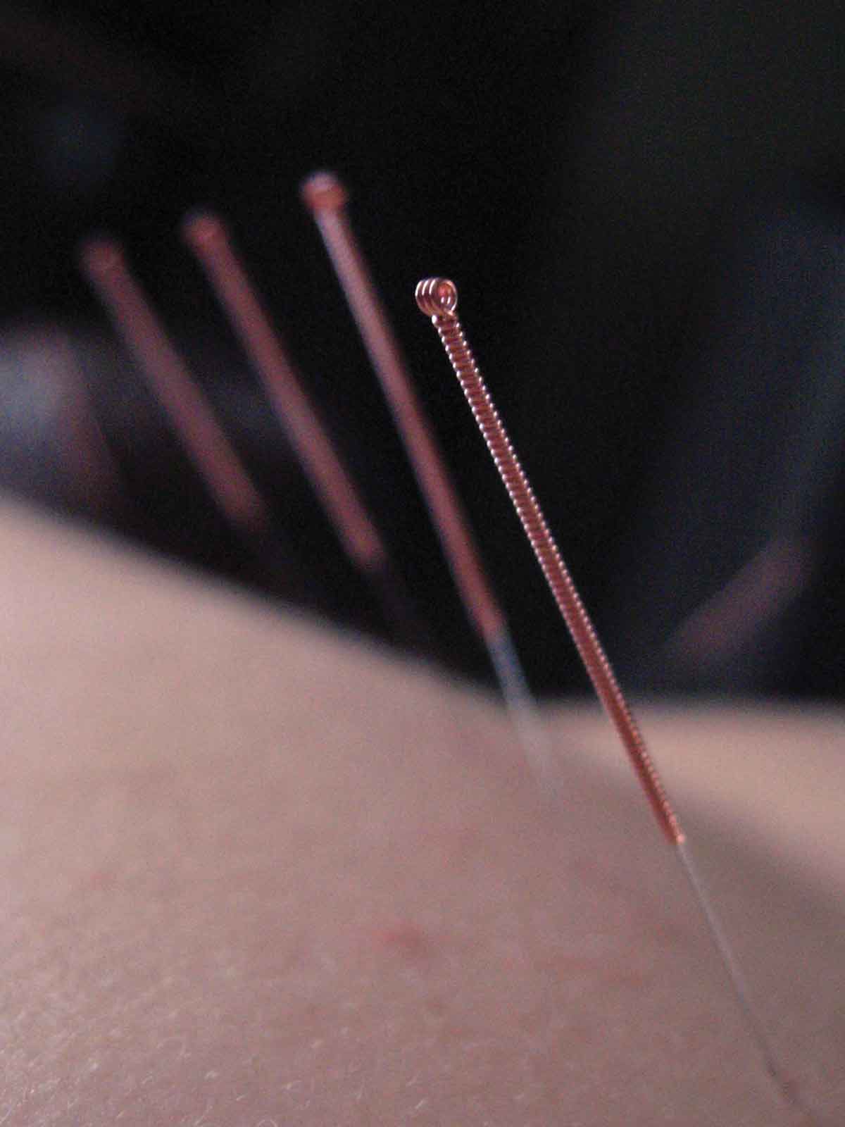 All Deep Acupuncture