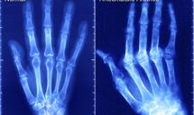 News on Rheumatoid Arthritis by All Deep Massage & Wellness Clinic