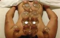 Cupping at All Deep Massage & Wellness Clinic