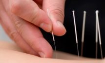 Acupuncture by All Deep Massage & Wellness Clinic