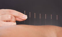Acupuncture in Sherwood Park, AB
