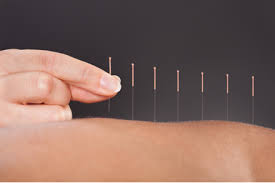 Acupuncture in Sherwood Park, AB