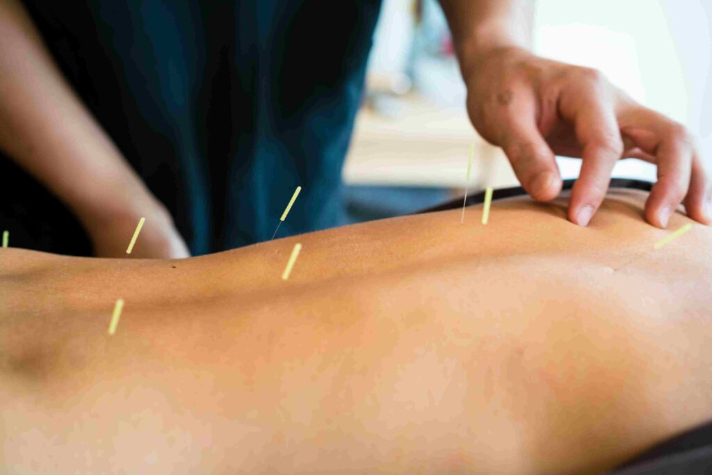Female Having Acupuncture Treatment With Expert in Sherwood Park, AB 