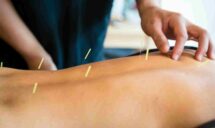 Female Having Acupuncture Treatment With Expert in Sherwood Park, AB