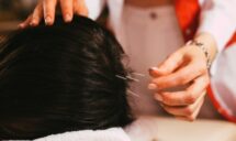 Acupuncture for Alopecia Treatment in Sherwood Park, AB