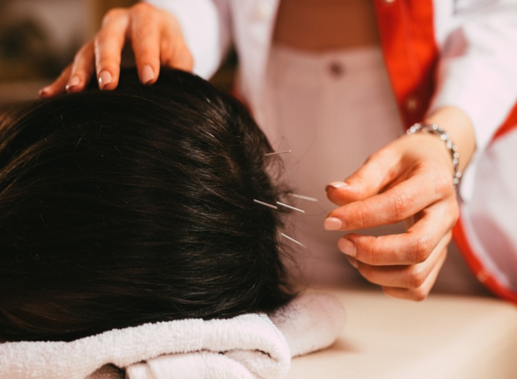 Acupuncture for Alopecia Treatment in Sherwood Park, AB