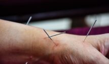 Acupuncture for Tendonitis Treatment in Sherwood Park, AB