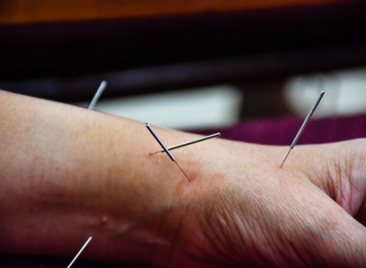 Acupuncture for Tendonitis Treatment in Sherwood Park, AB