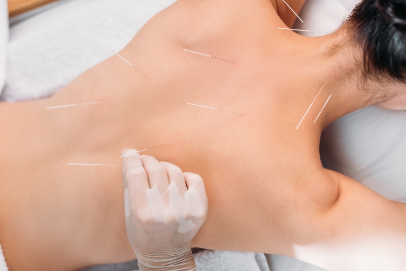 ELECTROACUPUNCTURE IN SHERWOOD PARK, AB