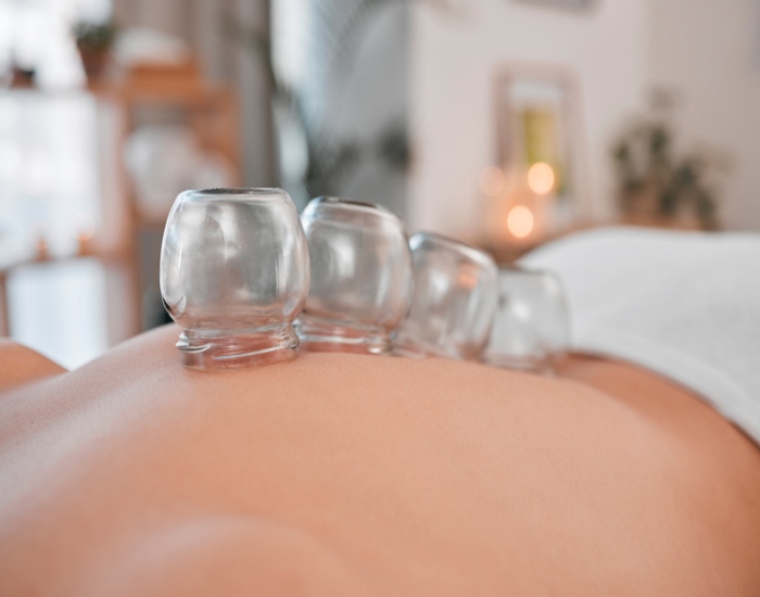Cupping Physical Therapy in Sherwood Park, AB