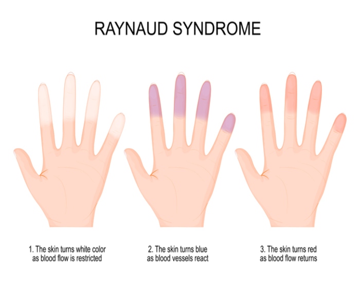 Raynaud's Phenomenon Hands Treatment in Sherwood Park, AB