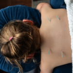 Acupuncture for Children Sherwood Park